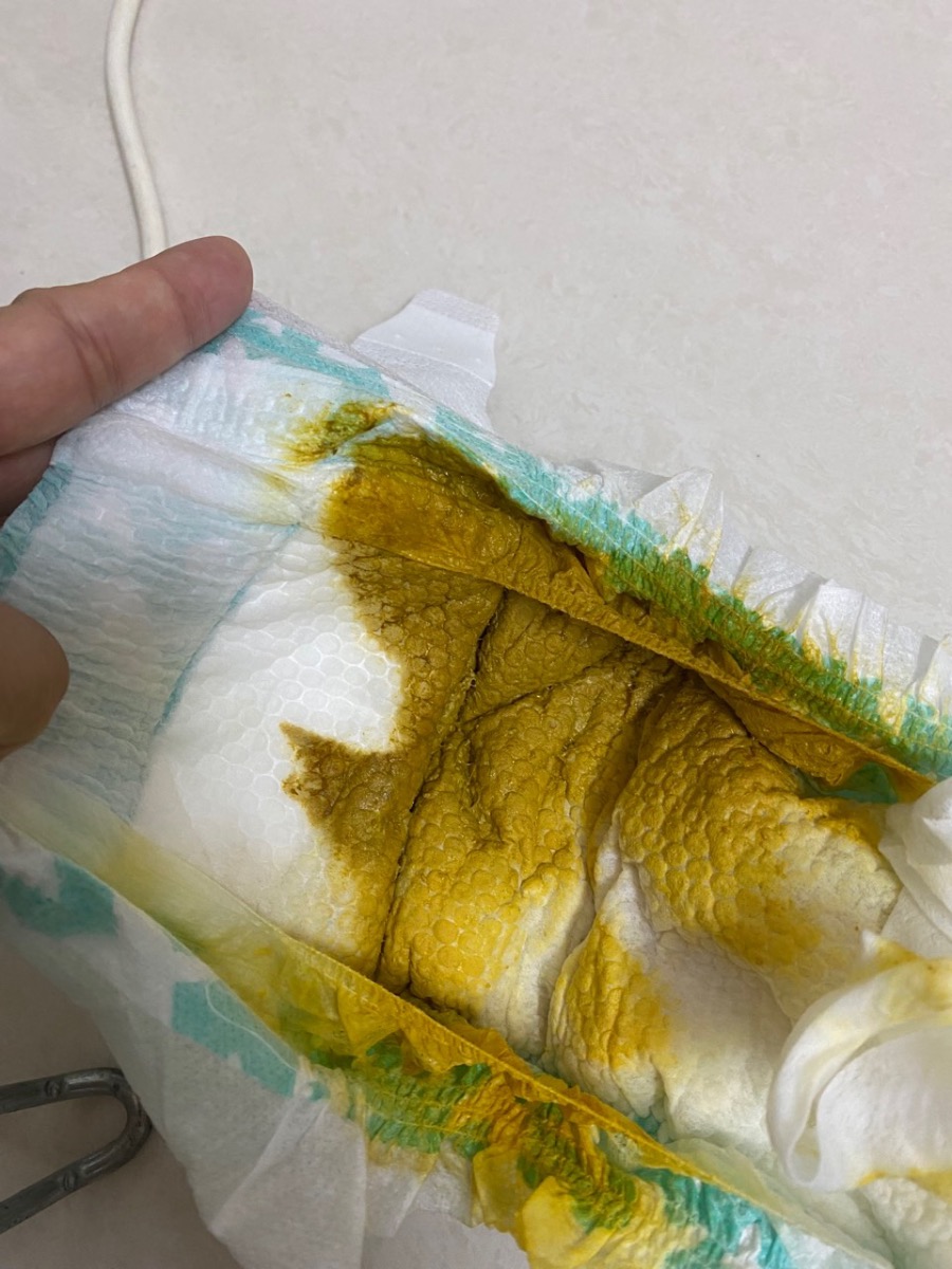 Bé có uống men vi sinh biobaiga mỗi ngày 5 giọt. Bé được 12d tuổi, có vàng da nhẹ nay đã đỡ. Hiện tại phân bé đi màu vàng và lỏng, có mùi hôi. Liệu có vấn đề gì k hay chỉ là tiêu hoá tốt. Do bé cũng k quấy khóc gì.