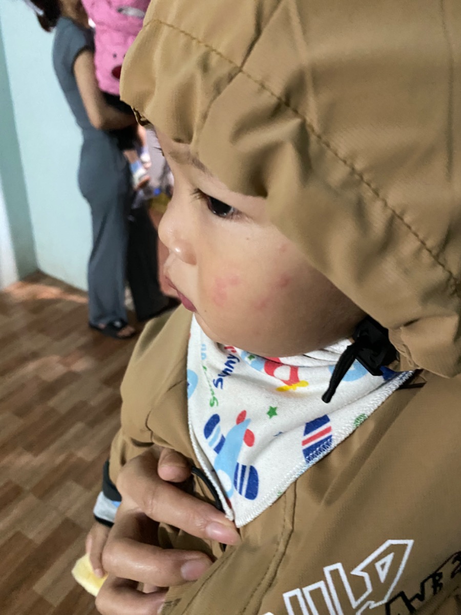 Bé nhà em dạo này hay bị nổi nốt ở má và 2 chân từ mông xuống,,,, bị xong hơi ngứa được 1 lúc lại tự lặn k biết là bé bị sao ạ