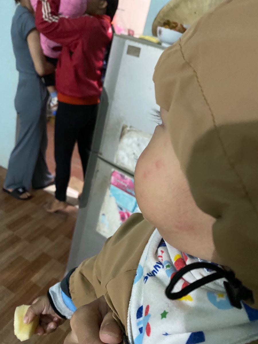 Bé nhà em dạo này hay bị nổi nốt ở má và 2 chân từ mông xuống,,,, bị xong hơi ngứa được 1 lúc lại tự lặn k biết là bé bị sao ạ