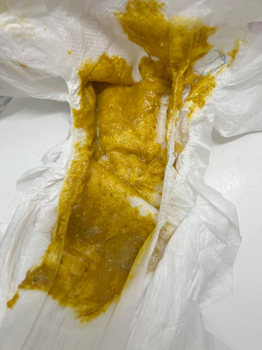 Con e 1m24 ngày đi phân e thấy có chất nhầy, bé ị ngày 1 lần, bé dùng sct và sữa mẹ, vẫn ăn ngủ bình thường ạ. Phân như vậy có sao không ạ . Em cảm ơn ạ