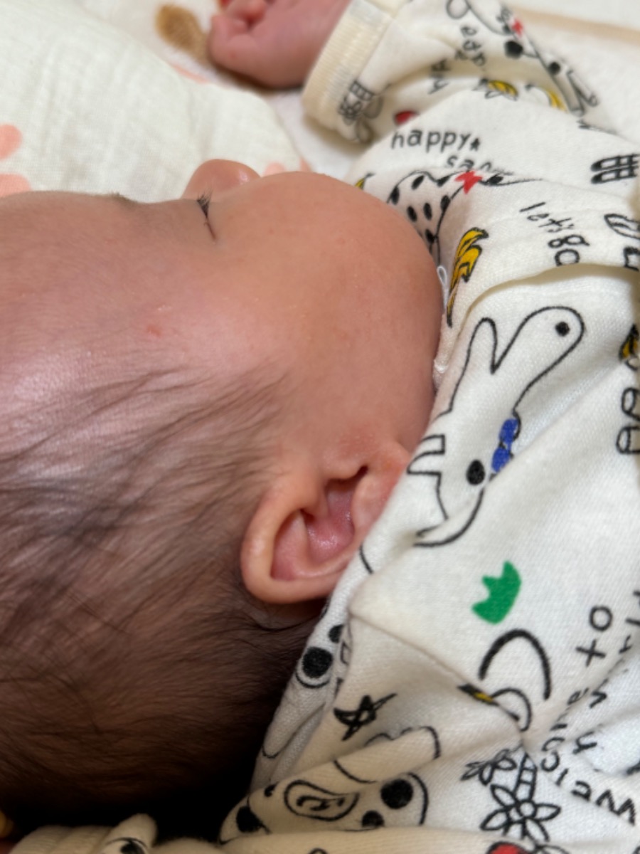 Admin cho e hỏi đây là mụn kê phải kg ? Bé nhà E 1 tháng 2 hôm nay thấy nó nổi nhiều hạt li ti bên cánh tai khá dày và bên cạnh má giờ cũng dsg nổi lên ? Có phải mụn kê k ạ ? Có cách nào cho hết k và dùng dầu dừa bôi được k ạ.