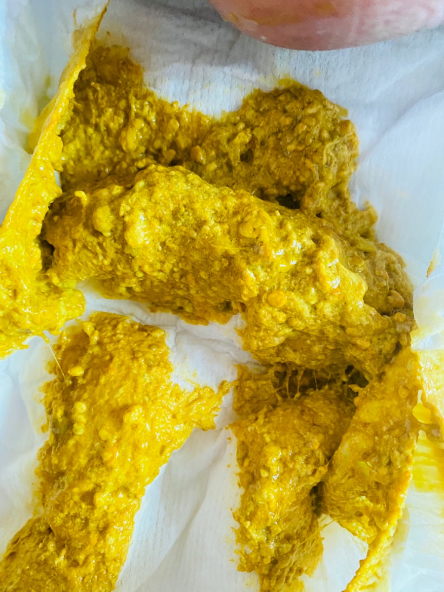 Ba xem giúp e phân ntn là ổn ko ạ . Bạn sinh được 1 tháng 2 ngày uống cả sct và sữa mẹ ạ