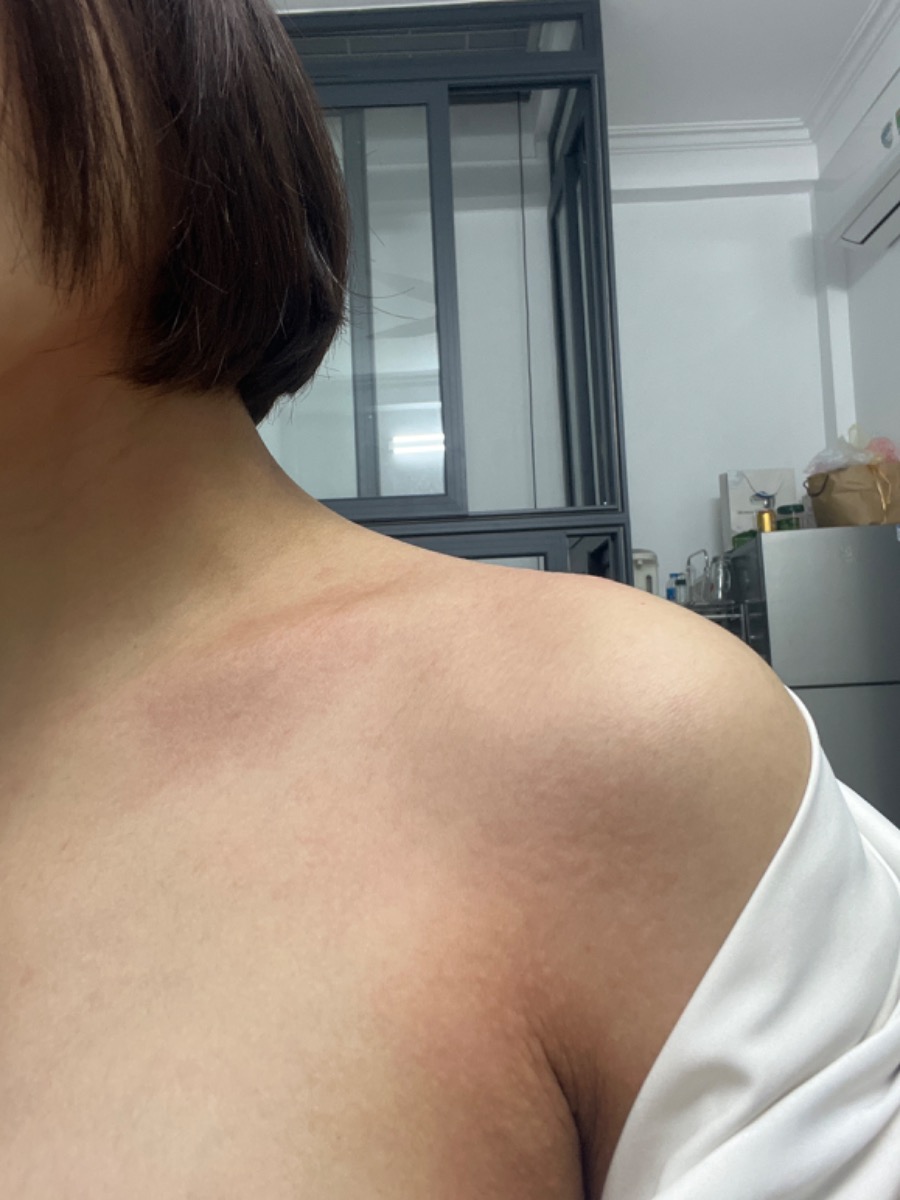Chuyên gia cho hỏi: 
Mẹ bầu 36 tuan phát ban mẩn ngứa phát ban thì có sao không ạ?