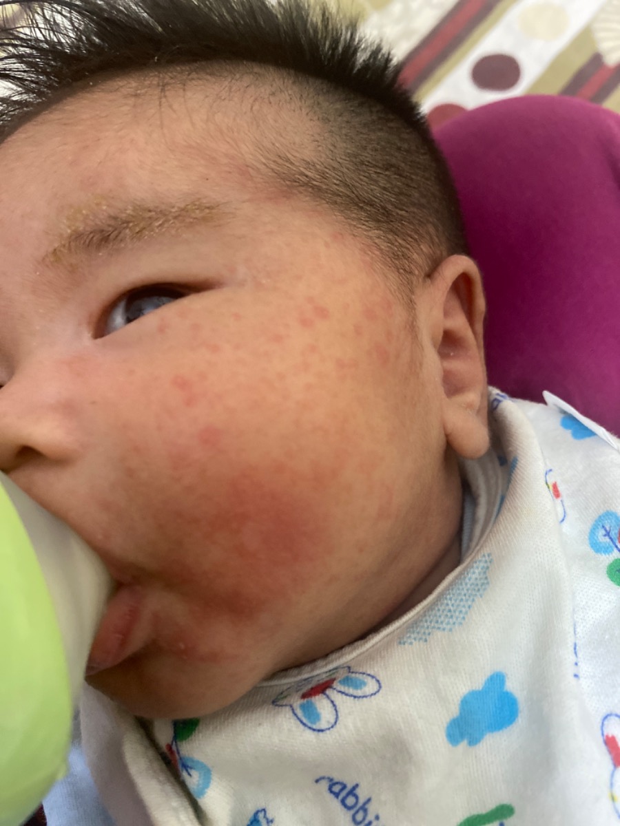 Bạn ấy Một tháng ba ngày tuổi, những ngày đầu mọc giống như Rôm, Nhưng bây giờ lại kéo về một đoạn hai má đây có phải là chàm sữa