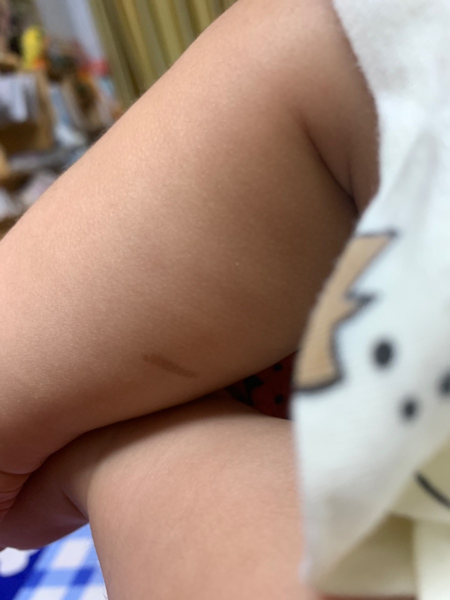 Bé nhà em ba tháng năm ngày tuổi từ lúc sinh ra bắp chân bé có một cái bớt nhưng bé lớn lên bớt  lớn dần theo vậy có cách nào làm Mờ vết bớt cho bé được không ạ