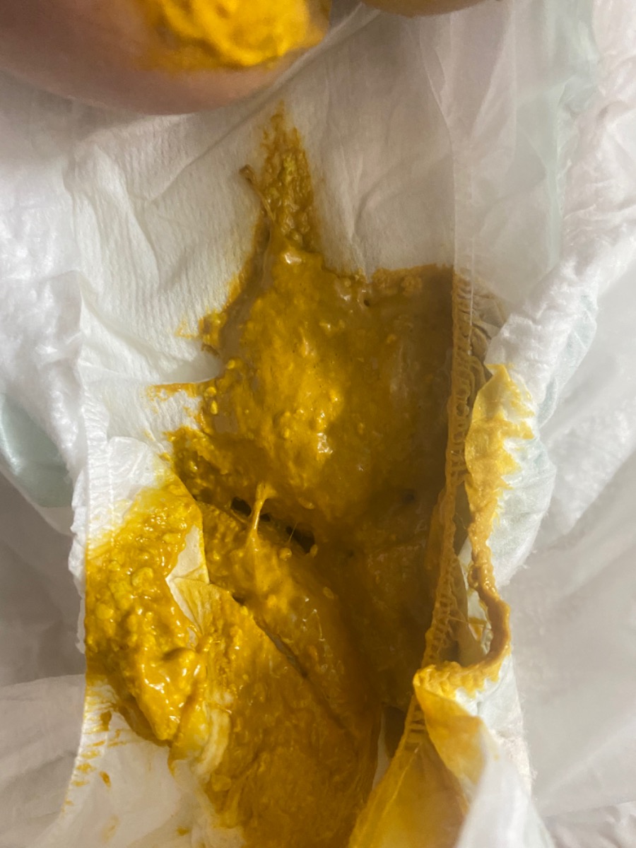 Bé nhà e hơn 2m đi đại tiện trung bình 2 ngày/ lần .nay thấy phân lỏng có chút bọt khí. Có sao ko ạ . Nếu bị thì nên khắc ohujc ntn ạ