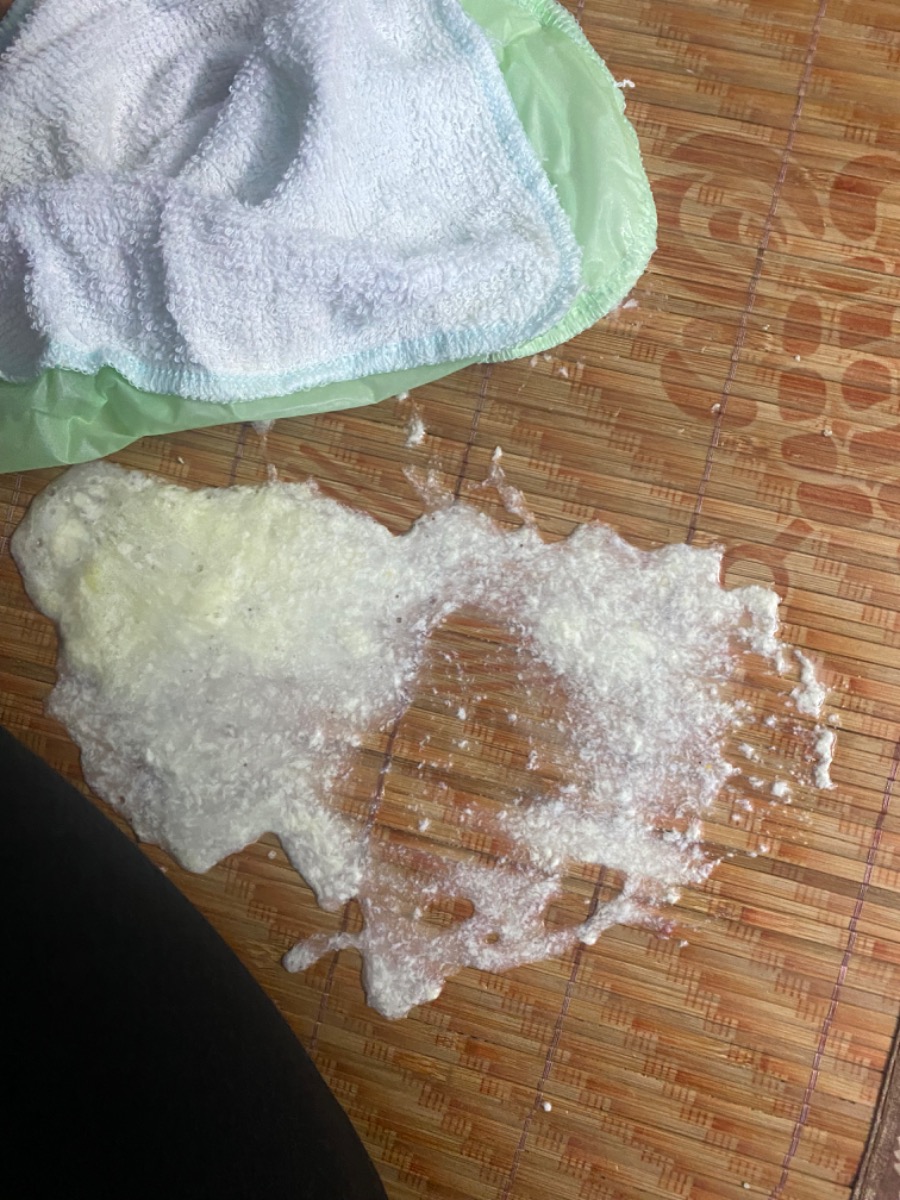 Chuyên gia giúp mình với ạ. Con mới sinh được 5 ngày tuổi, bác sỹ nói dạ dày con nằm ngang quá, rất dễ bị nôn trớ tuy nhiên con lại rất hấu ăn, đòi bú nhiều, xin chuyên gia giúp mình cách khắc phục ạ, con sinh lúc 38 tuần 6 ngày, cân nặng 3kg, mình đang áp dụng easy 3. Sáng nay ăn 2 cữ vào lúc 12h đêm và 4h30; sau khi ăn xong thì mình có vỗ ợ hơi và nằm sấp như hình dưới đây để đưa con vào giấc ngủ, thì có hiện tượng bé nôn như hình, tư vấn giúp mình phương pháp khắc phục với ạ