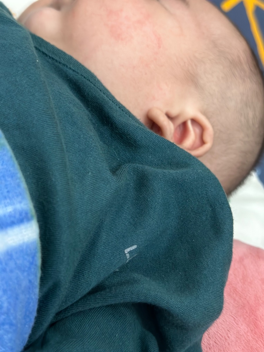 Nay bé em được gần 4m nhưng cứ tái đi tái lại vết đỏ Hoài ở mặt có phải chàm sữa hay bé bị nóng ạ , nhiệt độ phòng luôn 28 độ , em cũng vệ sinh và sử dụng kem chàm sữa Kutieskin cho bé 3 lần / ngày mà mãi vẫn k hết , cứ ẩn rồi lại hiện mãi. Bé bú sct hoàn toàn chỉ bú mẹ khi ngủ . Bé hay nổi ở 2 bên má như vết mụn , nay có xuất hiện lấm tấm trên trán 
Liệu có cách nào khiến hồi phục không ạ