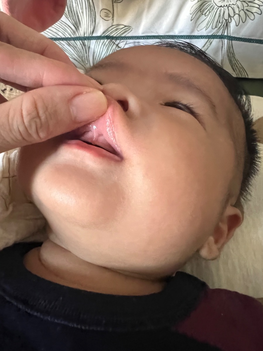 Hi ad! Cho mình hỏi em bé mình có phải bị dính thắng lưỡi trên rồi đúng không ạ? Và hướng xử lý như thế nào vậy ạ?