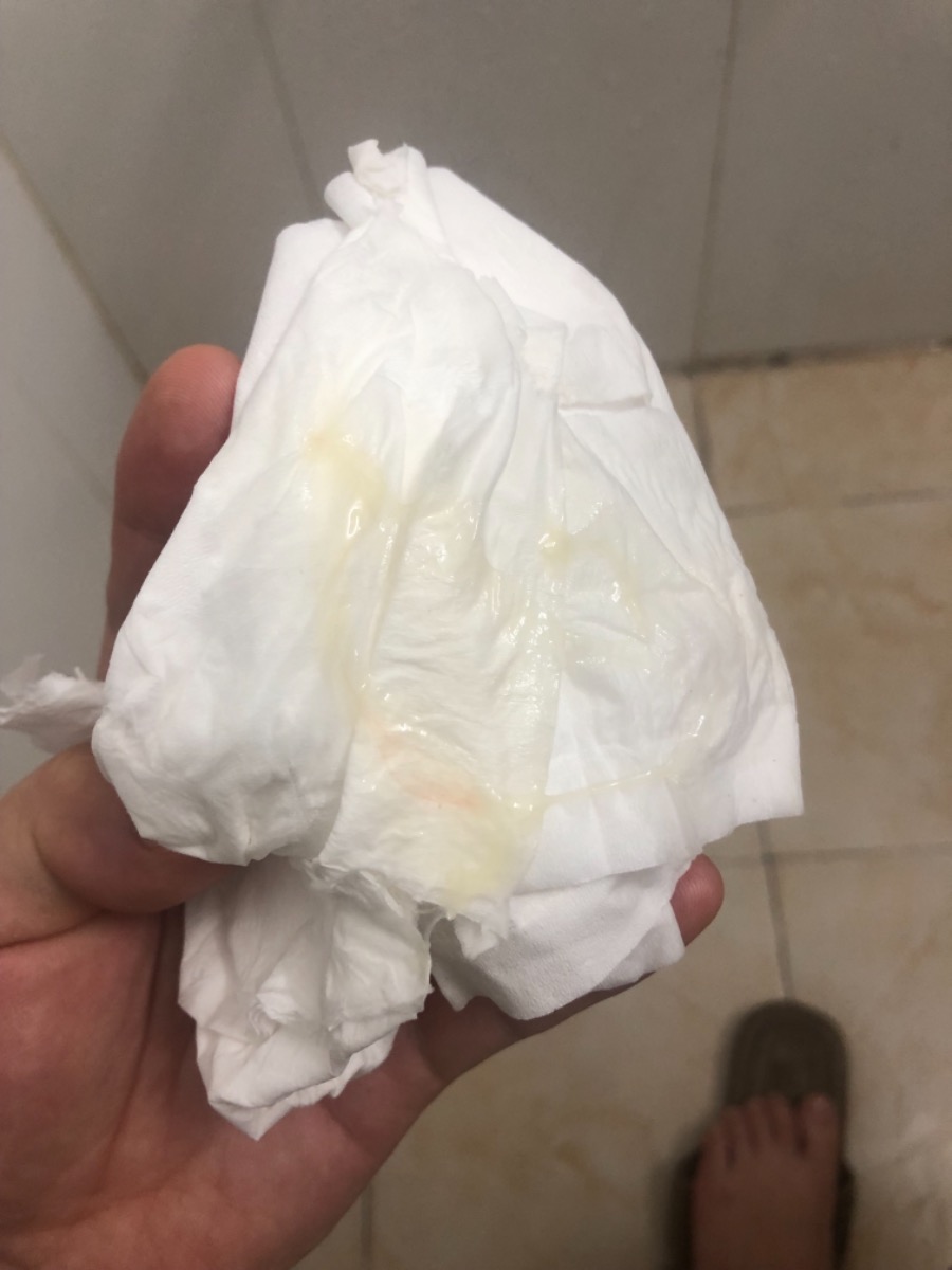 Cho mình hỏi như này có phải là hiện thượng bong nút nhày cổ tử cung chưa ạ