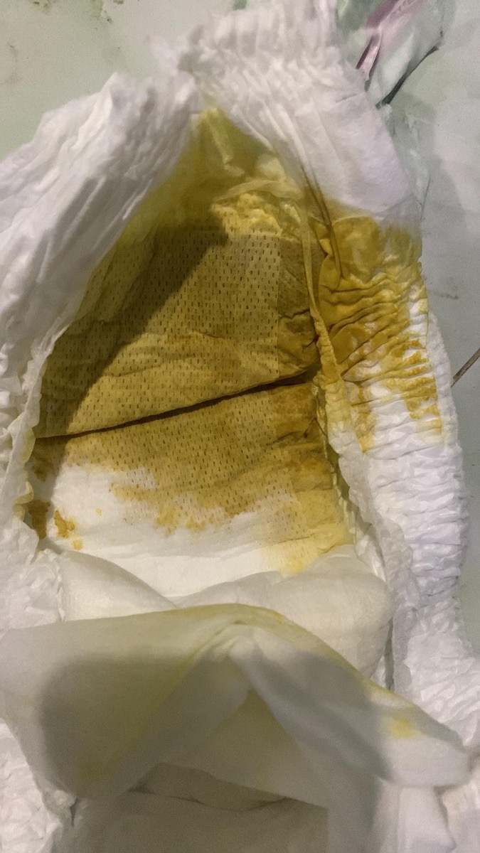 Bác sỹ ơi cho em hỏi, bé em hai tháng, đi ngoài 2-3 lần/ngày. Bốn ngày gần đây bé đj ngoài nhiều nước như ảnh, không có hạt. Bé bú và chơi bình thường. Bác cho e hỏi bé có phải tiêu chảy không ạ?