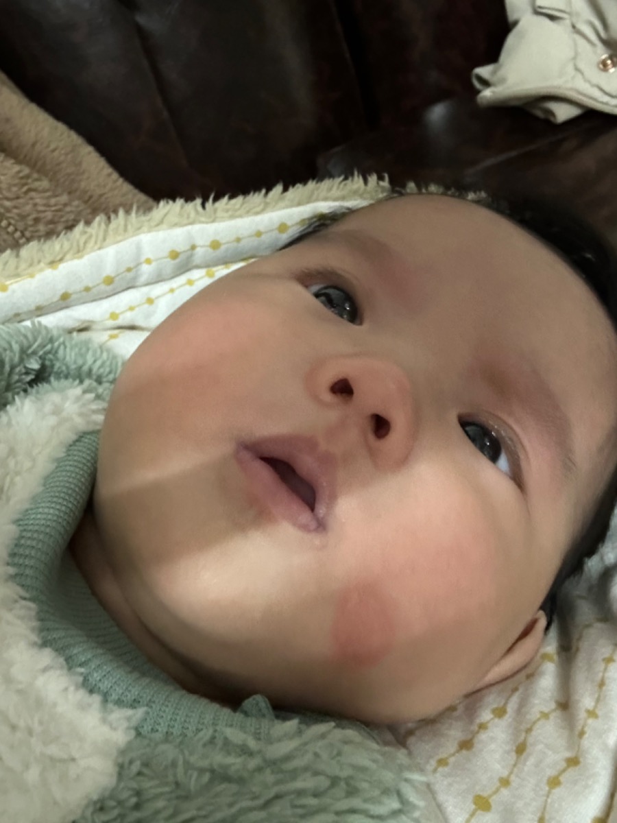 Bé nhà mình bị vết này đc khoảng hơn tuần r, mấy hôm đầu thì đốm bé xíu mà giờ nó bị lan to ở má, mình ko biết bé bị sao, bôi kem hăm r mà con ko đỡ. Nhìn nó chóc da như kiểu vết bỏng xầy ra luôn
