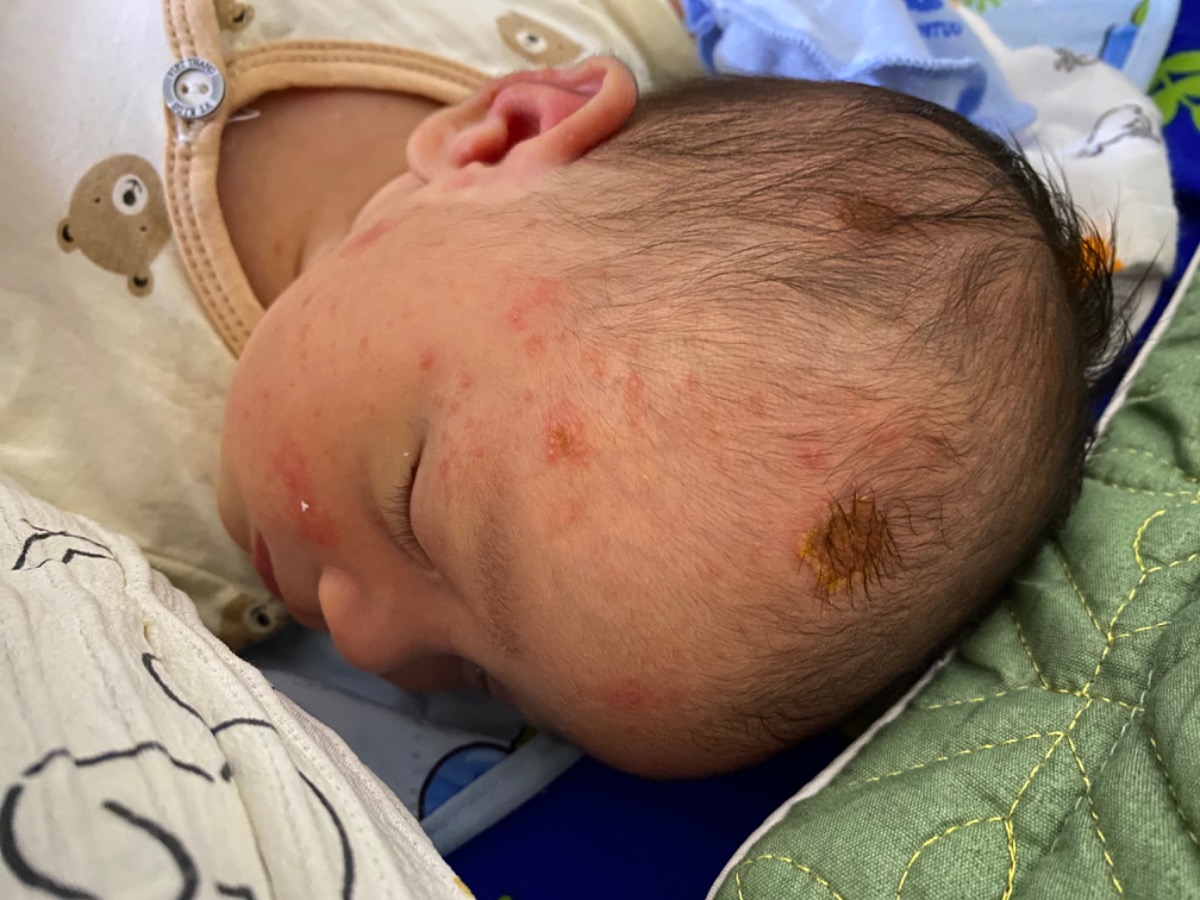 Bé nhà em bị các nốt như ảnh có phải bị chàm sữa không ạ? Phải xử lý như thế nào để bé nhanh khỏi ạ