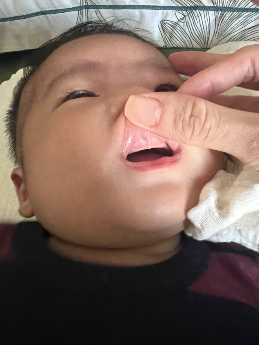 Hi ad! Cho mình hỏi em bé mình có phải bị dính thắng lưỡi trên rồi đúng không ạ? Và hướng xử lý như thế nào vậy ạ?