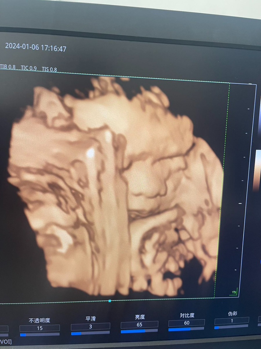 Cho e hỏi lúc 25tuan e đi khám siêu âm 4d bs bảo em bé bình thường mặt và tay chân điều thấy gõ , v là thai e bth dung không ạ