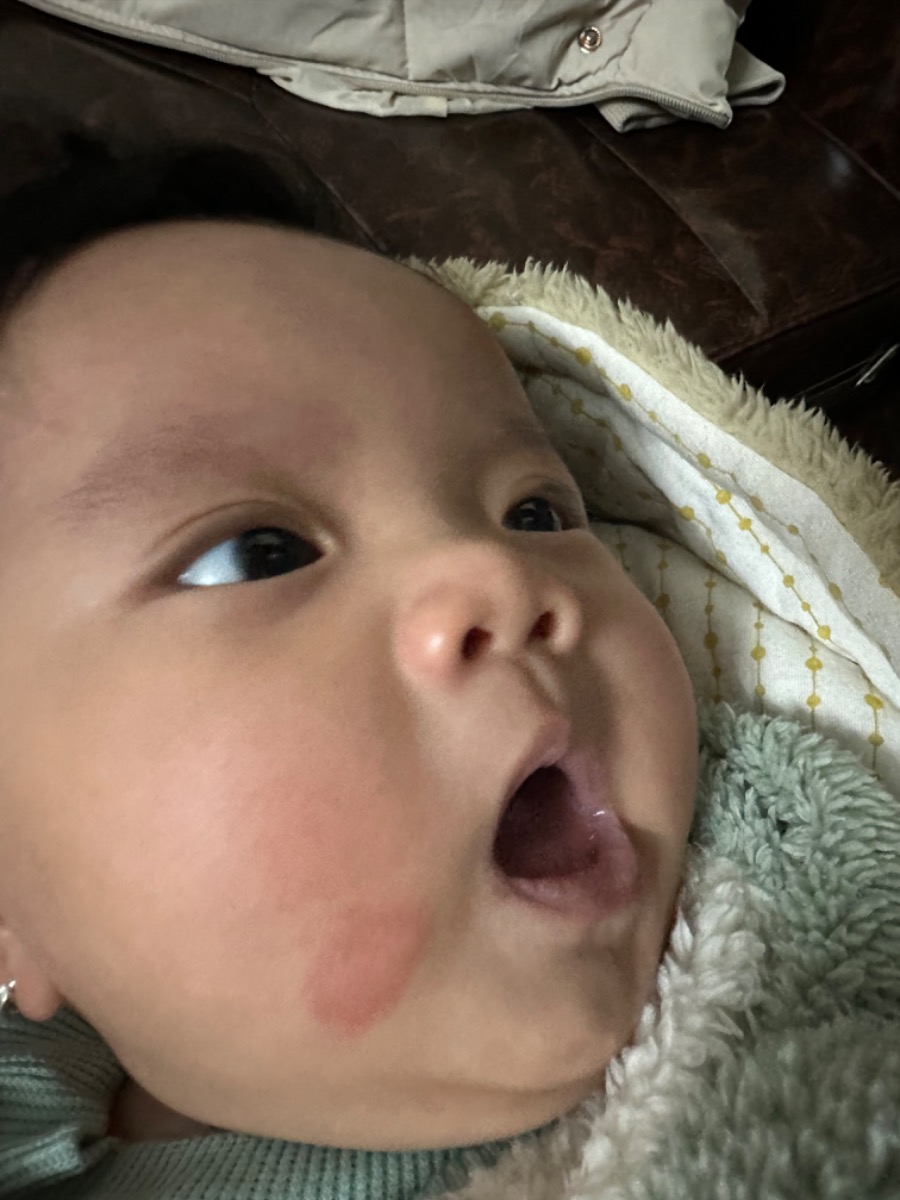 Bé nhà mình bị vết này đc khoảng hơn tuần r, mấy hôm đầu thì đốm bé xíu mà giờ nó bị lan to ở má, mình ko biết bé bị sao, bôi kem hăm r mà con ko đỡ. Nhìn nó chóc da như kiểu vết bỏng xầy ra luôn