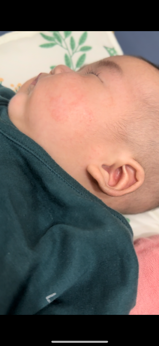 Nay bé em được gần 4m nhưng cứ tái đi tái lại vết đỏ Hoài ở mặt có phải chàm sữa hay bé bị nóng ạ , nhiệt độ phòng luôn 28 độ , em cũng vệ sinh và sử dụng kem chàm sữa Kutieskin cho bé 3 lần / ngày mà mãi vẫn k hết , cứ ẩn rồi lại hiện mãi. Bé bú sct hoàn toàn chỉ bú mẹ khi ngủ . Bé hay nổi ở 2 bên má như vết mụn , nay có xuất hiện lấm tấm trên trán 
Liệu có cách nào khiến hồi phục không ạ