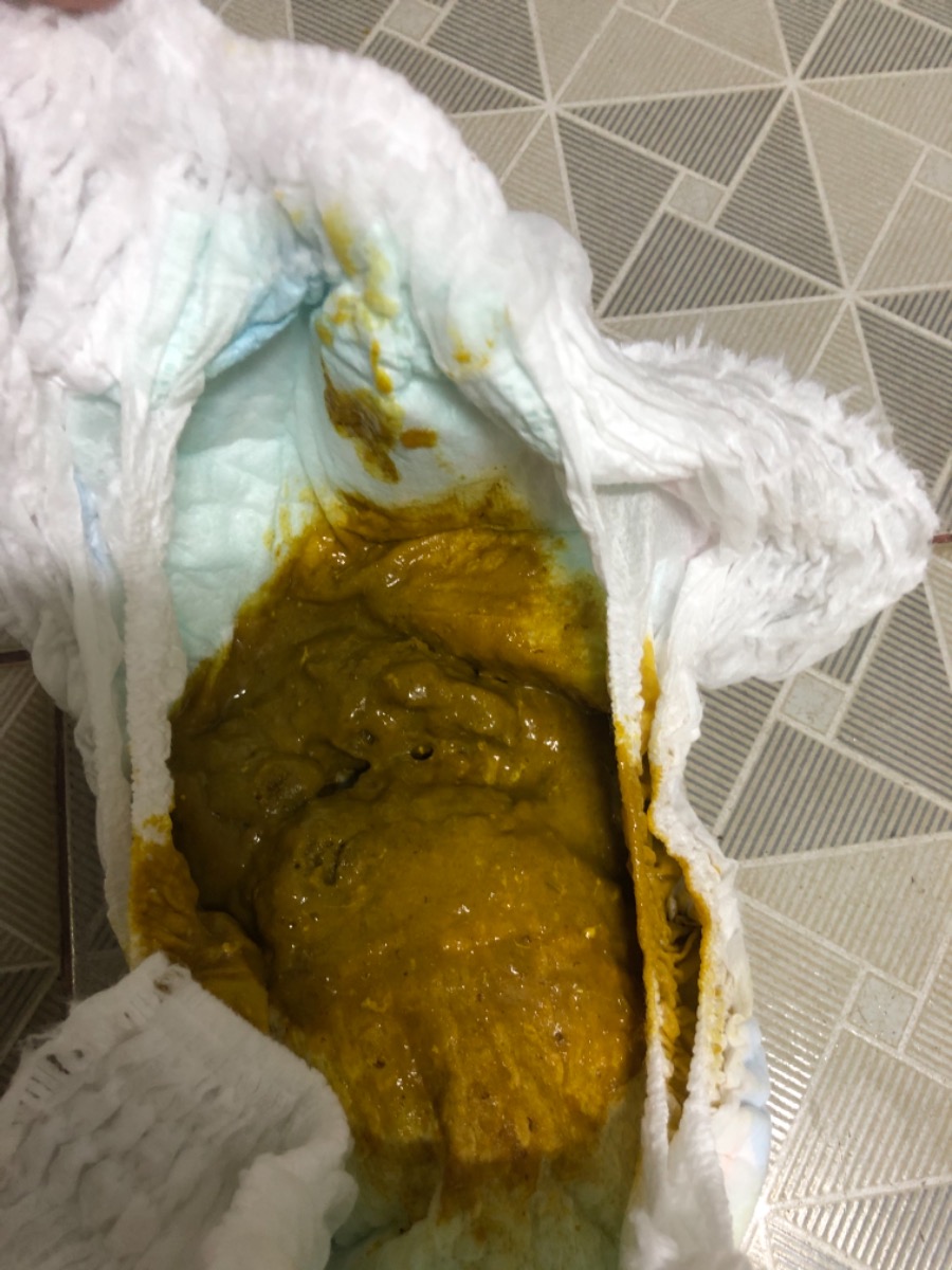 Bé nhà mình được 6M 5  ngày tuổi, nặng 7kg( lức sinh là 3,5 kg), bú mẹ hoàn toàn. Lúc được 5M 20 Ngày tuổi mình bắt đầu cho bé ăn dặm nhưng chỉ ăn trái cây như bơ, chuối, xoài, thanh long với một lượng rất ít, tầm 1-2 muỗng cà phê, trái cây được nạo và lọc bằng rây, loại đặc như bơ thì mình có hoà với sữa mẹ cho loãng dễ ăn, ăn vào buổi trưa song từ khi ăn thì bé chậm đi cầu, 7-8 ngày mới đi, phân sệt , màu sẫm đen chứ không vàng, phân nhiều bóp vào giống như cát mịn ( trước khi chưa ăn dặm thì bé đi cầu ngày 1 lần, có khi 4-5 lần, phân loãng)
Cho mình hỏi bé chậm đi cầu như vậy có phải bị bón không? Ngày thứ 8 bé đi cầu là do tác động từ bên ngoài chứ không phải tự đi( mẹ bơm cho bé theo hướng dẫn của dược sĩ bán thuốc)
Hiện tại bé đang chuyển qua ăn cháo với bí đỏ, cháo với khoai lang, cháo với khoai Tây nấu loãng, cà và lọc qua rây, 50-60ml/ ngày vào buổi sáng, đầu giờ chiều ăn dặm trái cây như chuối, đu đủ chín 
Đến ngày thứ 3 rồi bé vẫn chưa tự đi cầu!
- Xin hỏi tình trạng như thế có ảnh hưởng đến sức khỏe của bé không?
- việc ăn dặm của bé như vậy ổn chưa ah?