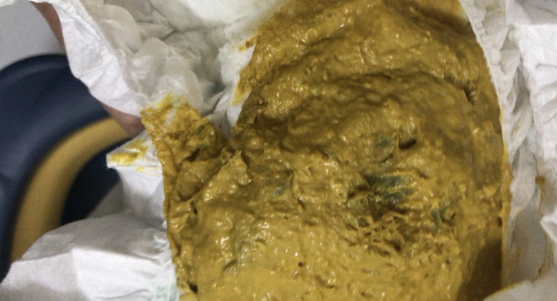 Bé nhà mình được 2m10d, ngày 11/3/2024 bé có đi tiêm vacxin 6in1 mũi 1 và uống Rota liều đầu tiền.

Sau tiêm về bé có ấm người nhiệt độ cao nhất đo được là 37.1 độ C, bé có dấu hiệu mệt và bú kém hơn ngày thường 10-20ml, khi bú bình đến gần cuối bé thường quần quại không yên.

Ngày 13/3 bé đi ngoài phân màu vàng sệt, nhưng xuất hiện chấm màu xanh (như ảnh)

Vậy chuyên gia cho mình hỏi trường hợp của bé cần lưu ý gì ạ?

Khi nào bé sẽ tiêm mũi phế cầu là tốt nhất  ạ?

Xin cảm ơn!