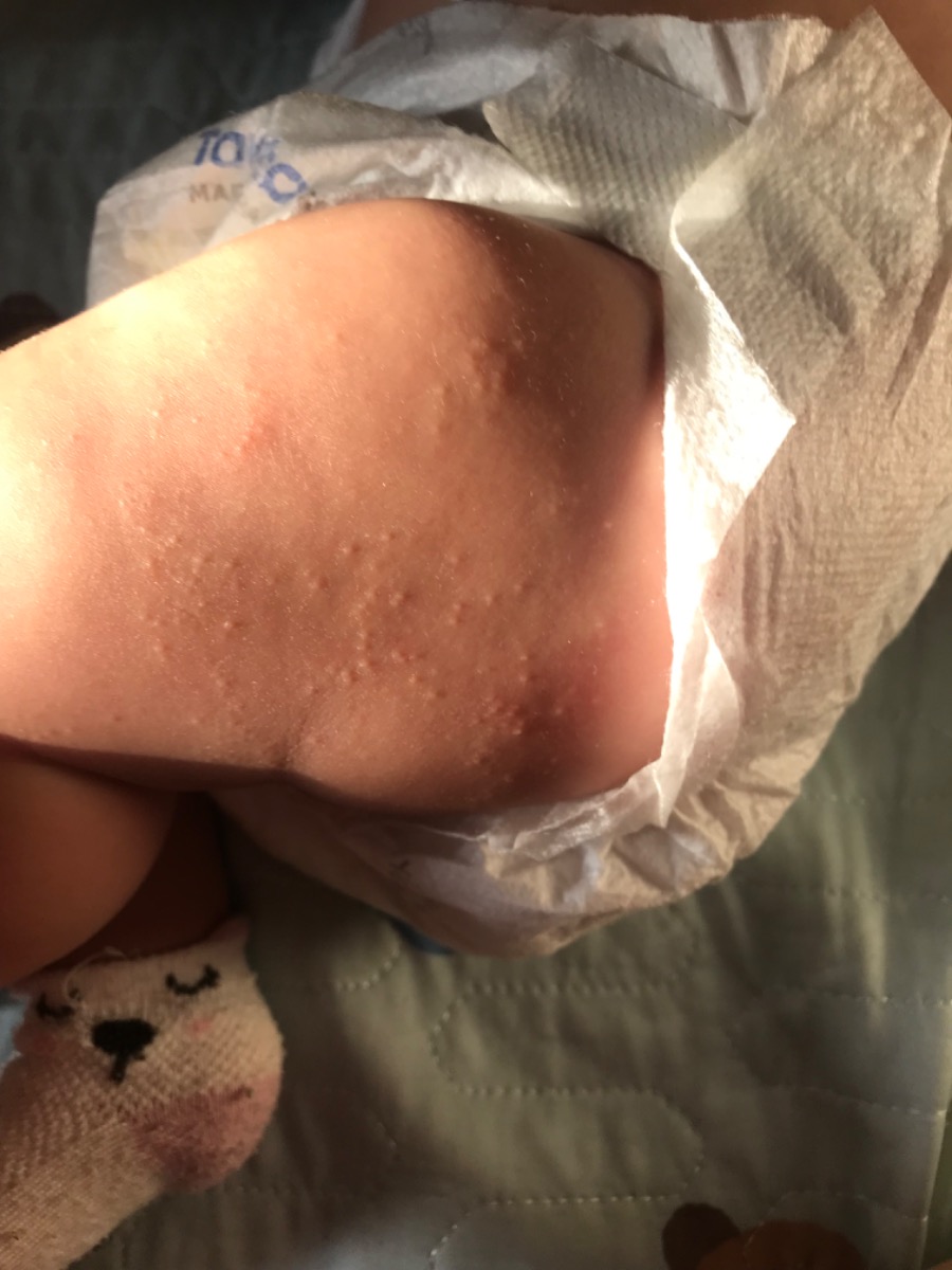 Cho e hỏi da hai bên đùi bé bị nổi nhiều mụn nhỏ li ti như này có làm sao ko ạ và điều trị như thế nào ạ.