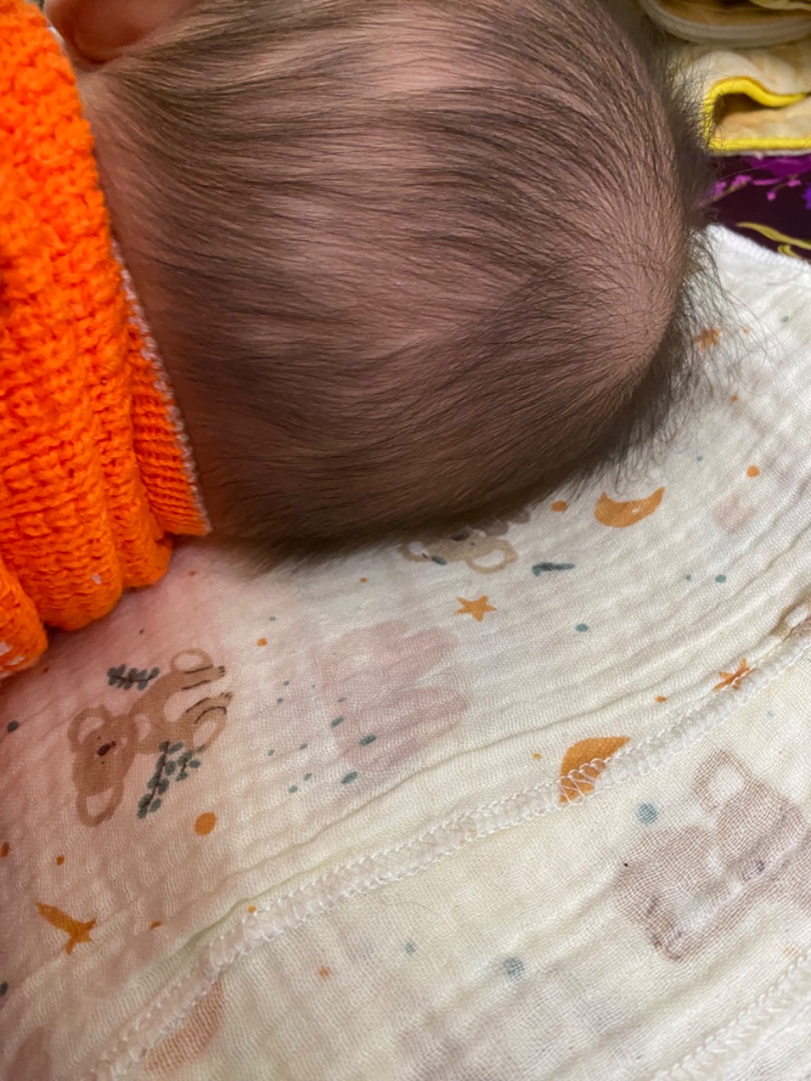 Bé nhà em 2m10d, hôm trước 8 ngày đị ị xong tiếp theo đến 8 ngày nay chưa ị, có sao không ạ? 
- Với 2 hôm nay bé có hiện tượng rụng tóc như ảnh ạ
Em cảm ơn ạ