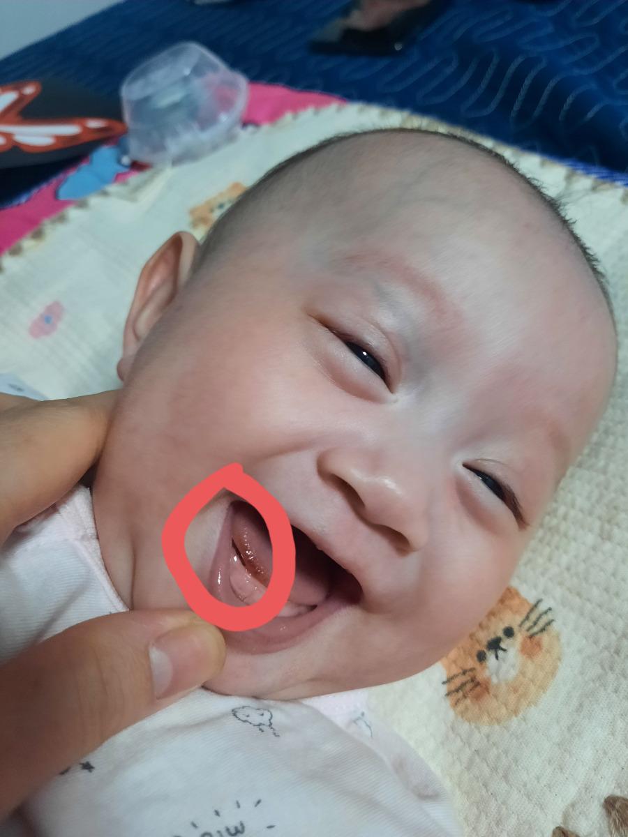 Đầu lưỡi bé nhà e bị hơi thâm đỏ như hình, cho em hỏi bé bị gì và có nguy hiểm gì không ạ?