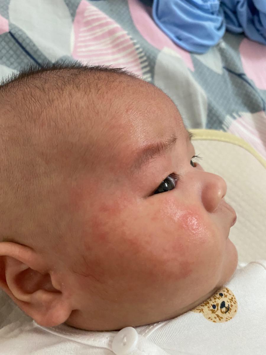 Da bé bị đỏ với nổi mụn ti ti 2 bên má khá nhiều. Xin hỏi bị vậy là sao ạ ? Có cần bôi gì cho bé ko ?