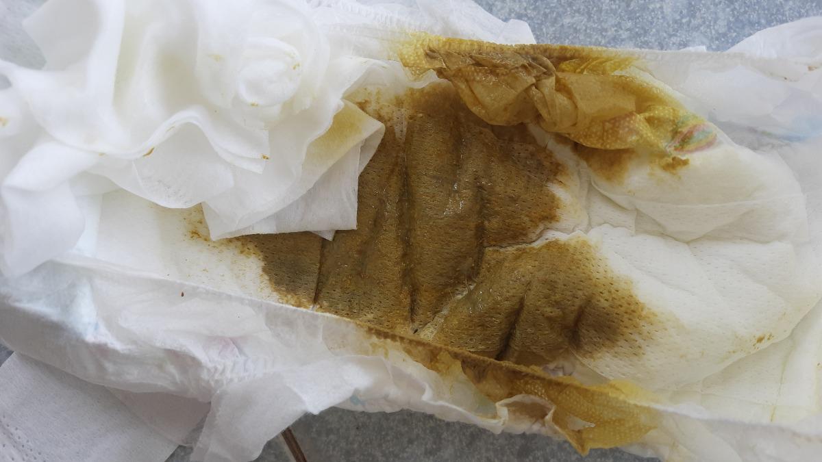 Bé ti bình sữa mẹ và sữa ct, 3 hôm nay đi ngoài ngày 2 lần. Có lần đi lúc vừa ti gần hết. Phân màu xanh, có hạt, phân lỏng hơn bt và có nhớt, phân thấm vào tả chứ k sệt như bt ạ (bình thường vẫn xanh nhưng k có hạt). Cho e hỏi tình trạng vậy có sao không ạ? 
Bé ăn ngủ bình thường, không đau bụng, không quấy khóc.