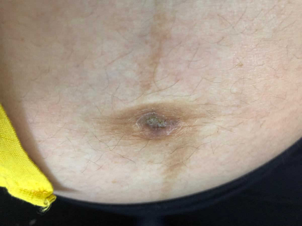 Bác sĩ ơi cho em hỏi cần vệ sinh rốn của mẹ như thế nào trong thai kỳ ạ