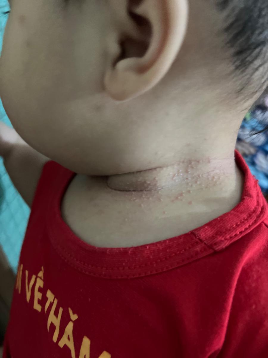 Con e nổi ntn khoảng 2tuan rồi e đã bôithuốc mà k đỡ phải làm thế nào ạ