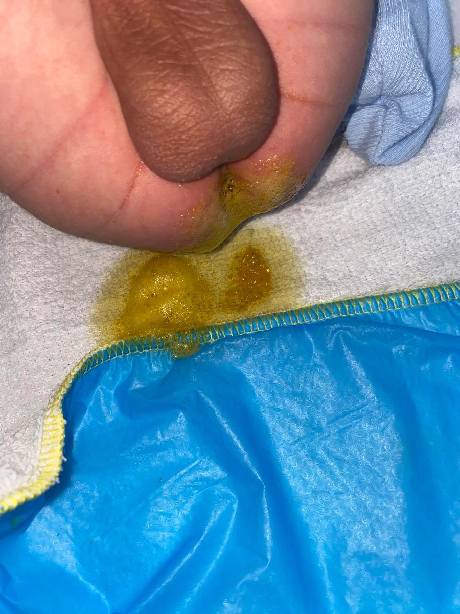 Bé đi phân lỏng, nhầy uống men bioflora được không Bs