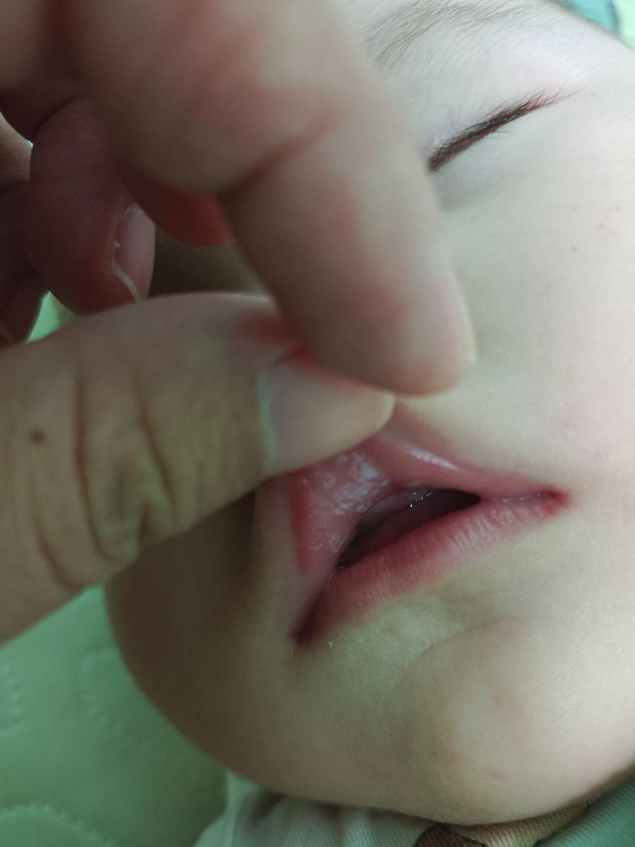 Bé nhà em được 5 tháng bị nổi như thế này ở miệng có sao không ạ???