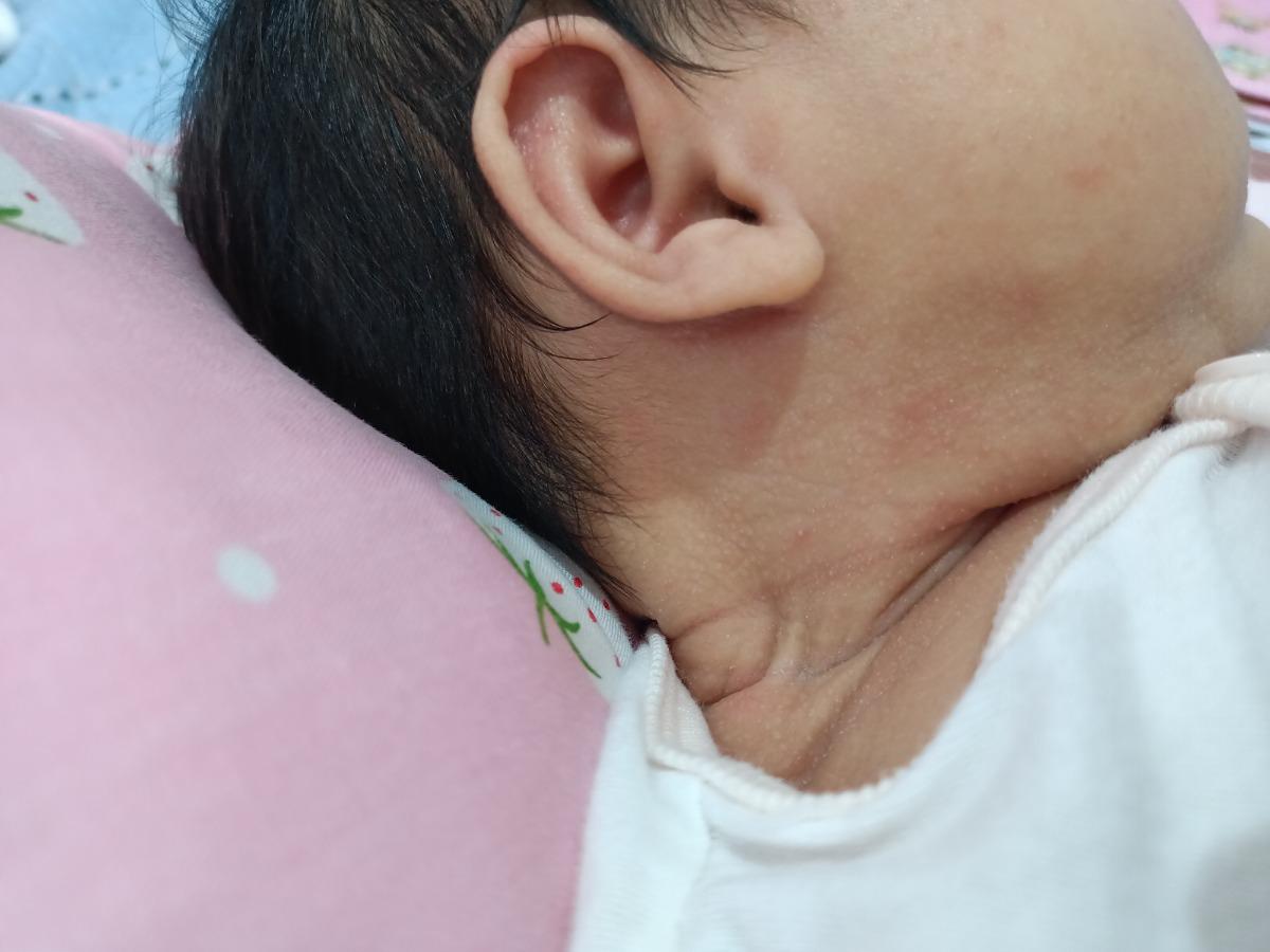 Bác sĩ ơi cho em hỏi. Em bé lên mụn này là bị gì ạ