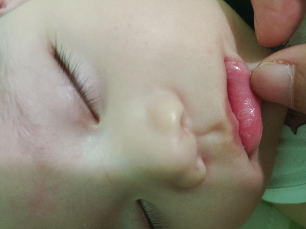 Bé nhà em được 5 tháng bị nổi như thế này ở miệng có sao không ạ???