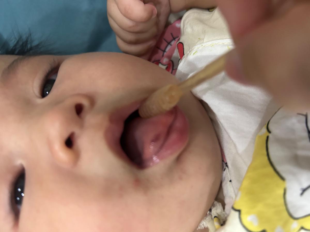 Lưỡi bé bị bầm ntn có phải tay chân miệng k ak. Bé ăn ngủ chơi bình thường ạ