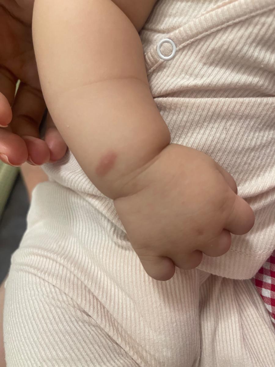 Bé nhà em 4 tháng 26 ngày tuổi, mỗi khi bị muỗi đốt thường sưng đỏ sau đó để lại vết thâm rất lâu ngày mới mờ dần. Bs cho em hỏi nên bôi thuốc hay làm gì để vết muỗi đốt của con mau lành ạ.