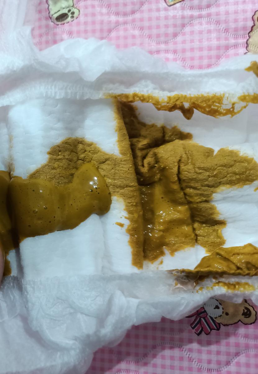 Bé nhà mình 2 tháng, bị sôi bụng nhiều, lúc sinh 3,5kg sau 2 tháng đc 4.8 kg, đi ngoài phân bọt. Mình cần làm gì ạ. Tăng cân như vậy có đạt yêu cầu ko ạ. Mình đã cho con uống men tiêu hoá mà vẫn k cải thiện