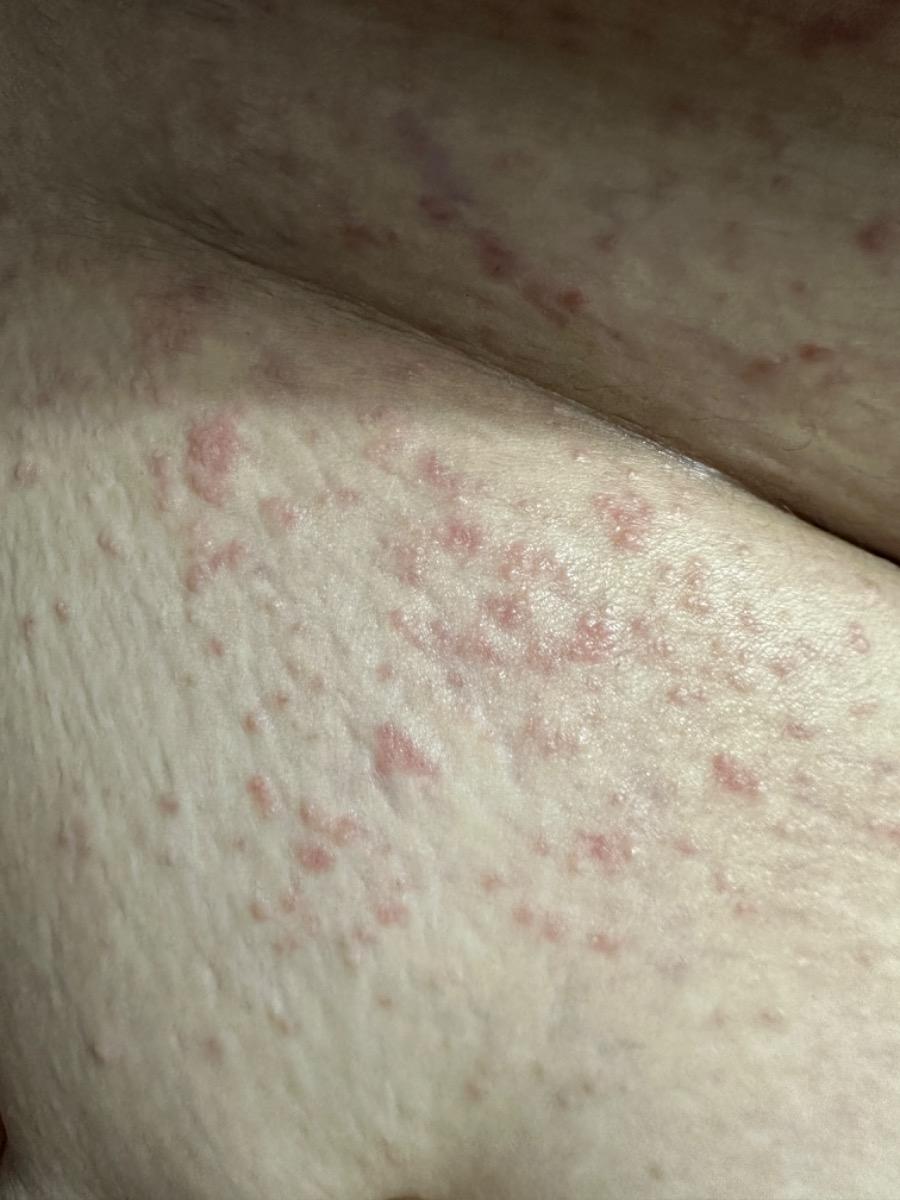 Hiện tại nhiều nơi trên cơ thể của em xuất hiện rất nhiều mụt như thế này và rất ngứa. Em đã đi khám da liễu và bôi nhiều loại thuốc nhưng vẫn không có dấu hiệu thuyên giảm. Cho em hỏi đây là bệnh gì và điều trị như thế nào ạ. Em bầu 31w ạ. Em cảm ơn!