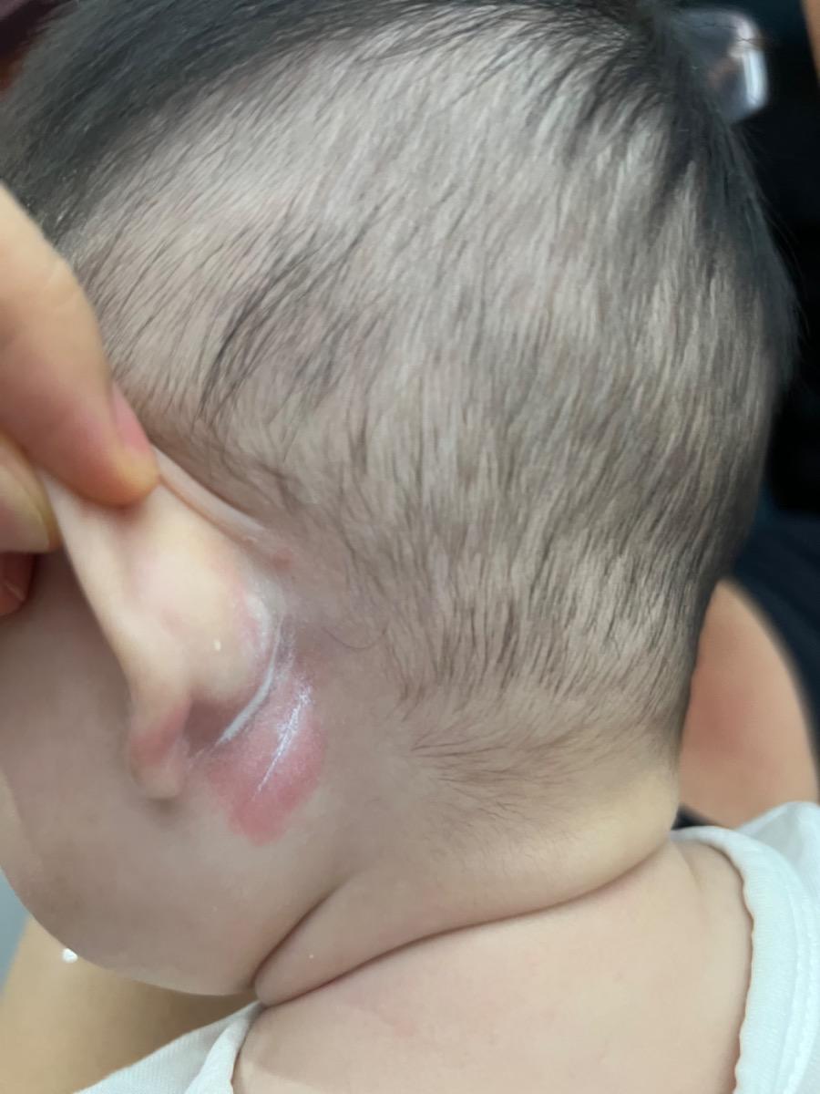 Cho mình hỏi bé nhà mình 5 tháng 20 ngày, 3 ngày nay tai bé xuất hiện vết đỏ như hình, mẹ hoang mang quá không biết bé bị sao và có nên đi khám không ạ?