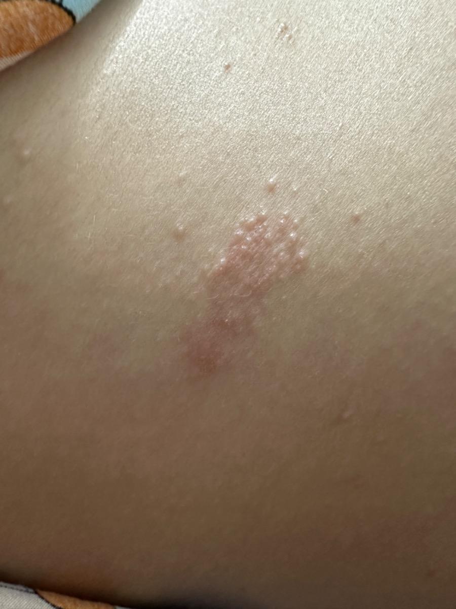 Hiện tại nhiều nơi trên cơ thể của em xuất hiện rất nhiều mụt như thế này và rất ngứa. Em đã đi khám da liễu và bôi nhiều loại thuốc nhưng vẫn không có dấu hiệu thuyên giảm. Cho em hỏi đây là bệnh gì và điều trị như thế nào ạ. Em bầu 31w ạ. Em cảm ơn!