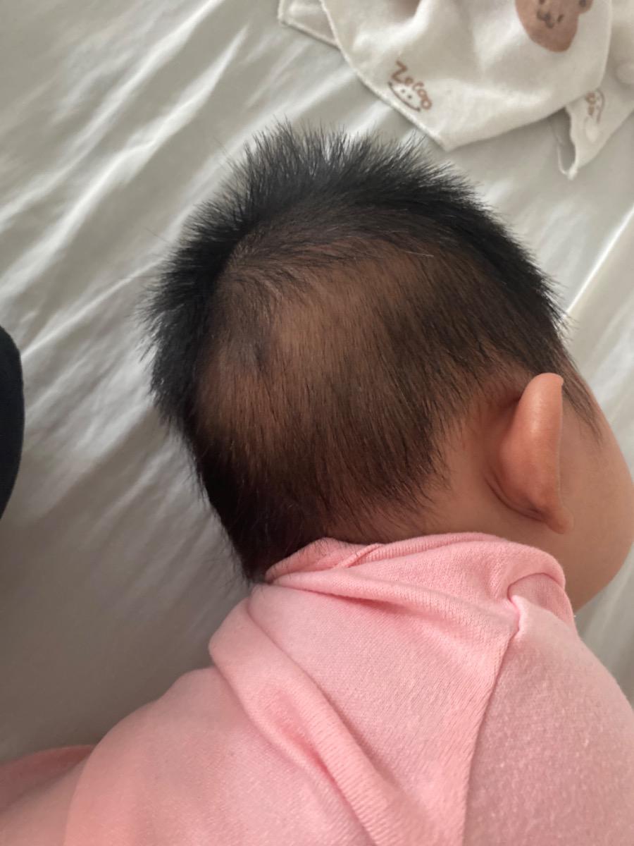 Bé 4 tháng tuổi bị rụng tóc thành vành sau đầu là bị sao ạ