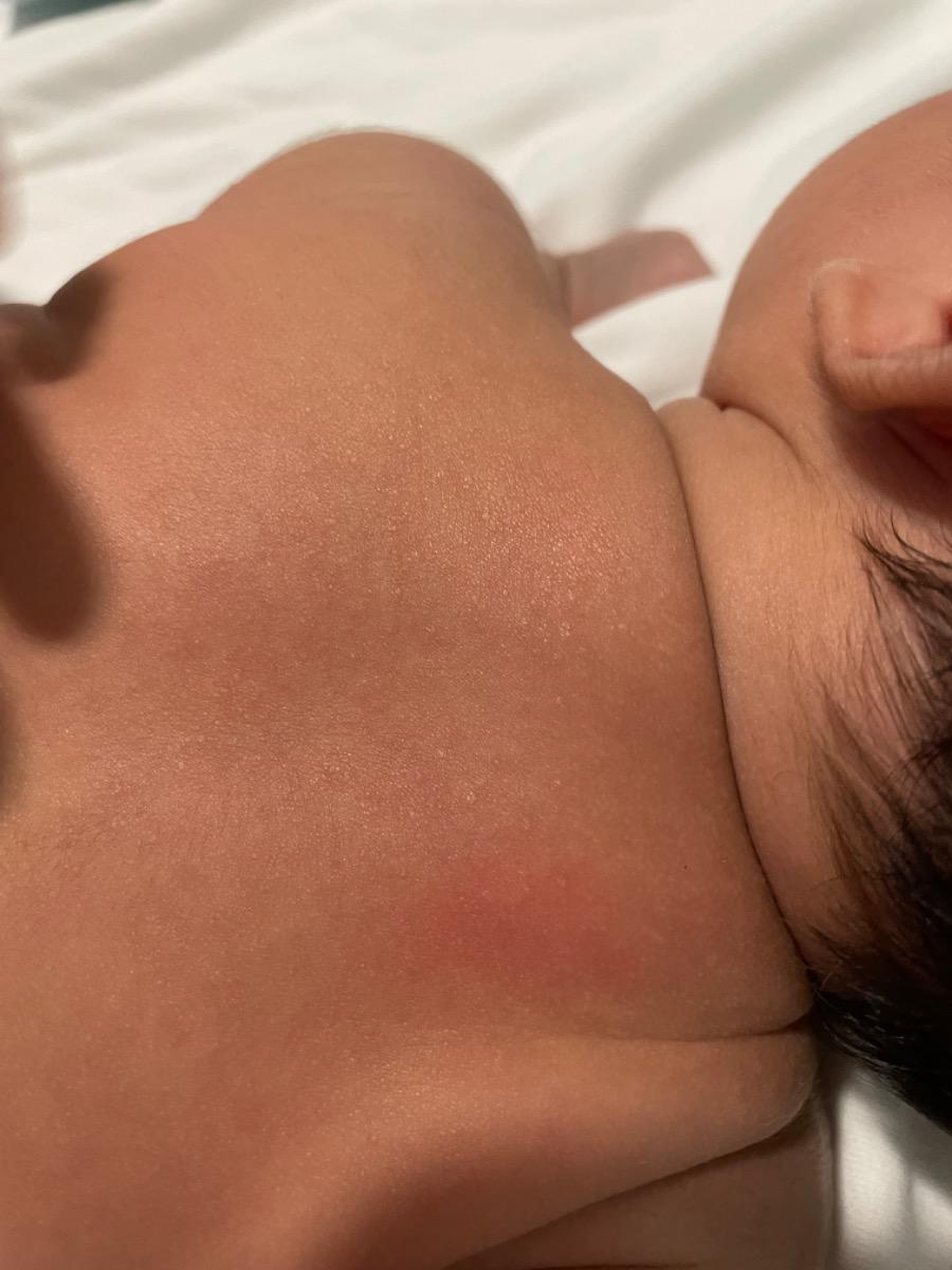 Cho mình hỏi: da em bé bị đỏ như hình là bị gì ạ, em bé bị 2 ngày r ạ