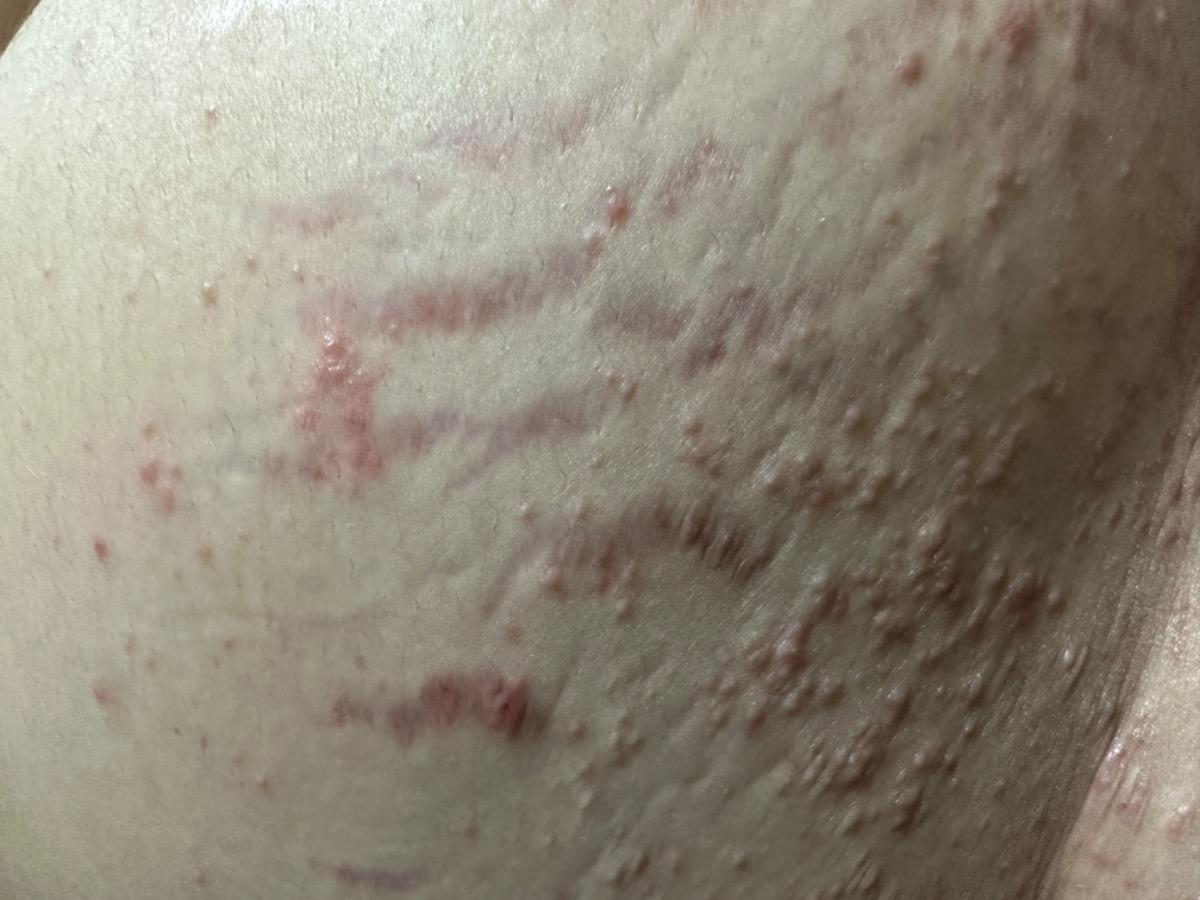 Hiện tại nhiều nơi trên cơ thể của em xuất hiện rất nhiều mụt như thế này và rất ngứa. Em đã đi khám da liễu và bôi nhiều loại thuốc nhưng vẫn không có dấu hiệu thuyên giảm. Cho em hỏi đây là bệnh gì và điều trị như thế nào ạ. Em bầu 31w ạ. Em cảm ơn!