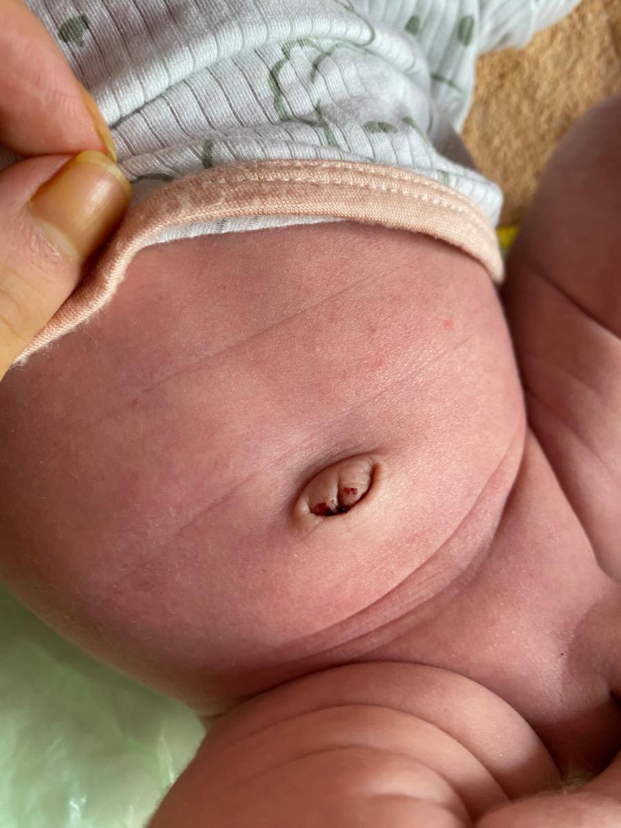 Bé nhà em 15 ngày có ứa máu ở rốn. Rốn bé rụng từ lúc được 1 tuần. Dạo gần đây bé rất hay vặn mình có phải do bé vặn mình rồi bị ứa máu không ạ?