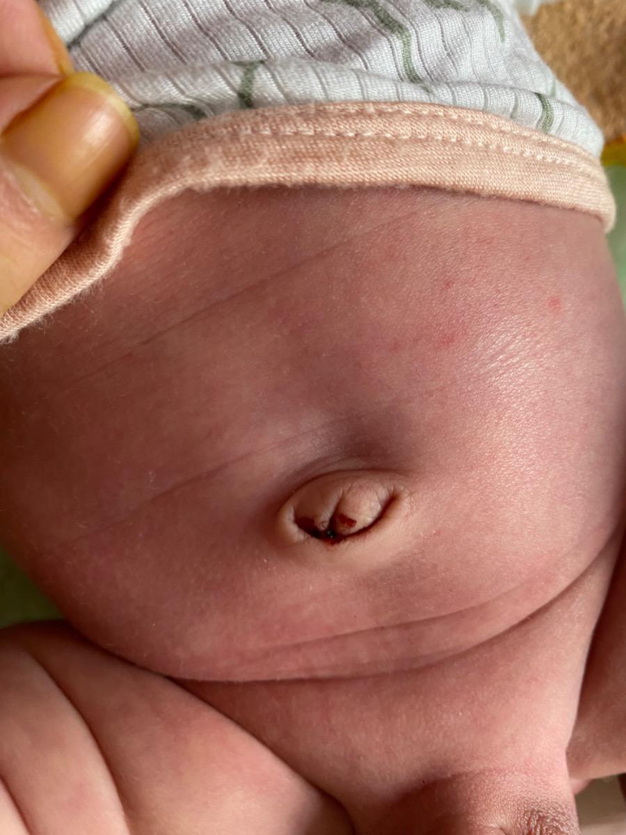 Bé nhà em 15 ngày có ứa máu ở rốn. Rốn bé rụng từ lúc được 1 tuần. Dạo gần đây bé rất hay vặn mình có phải do bé vặn mình rồi bị ứa máu không ạ?