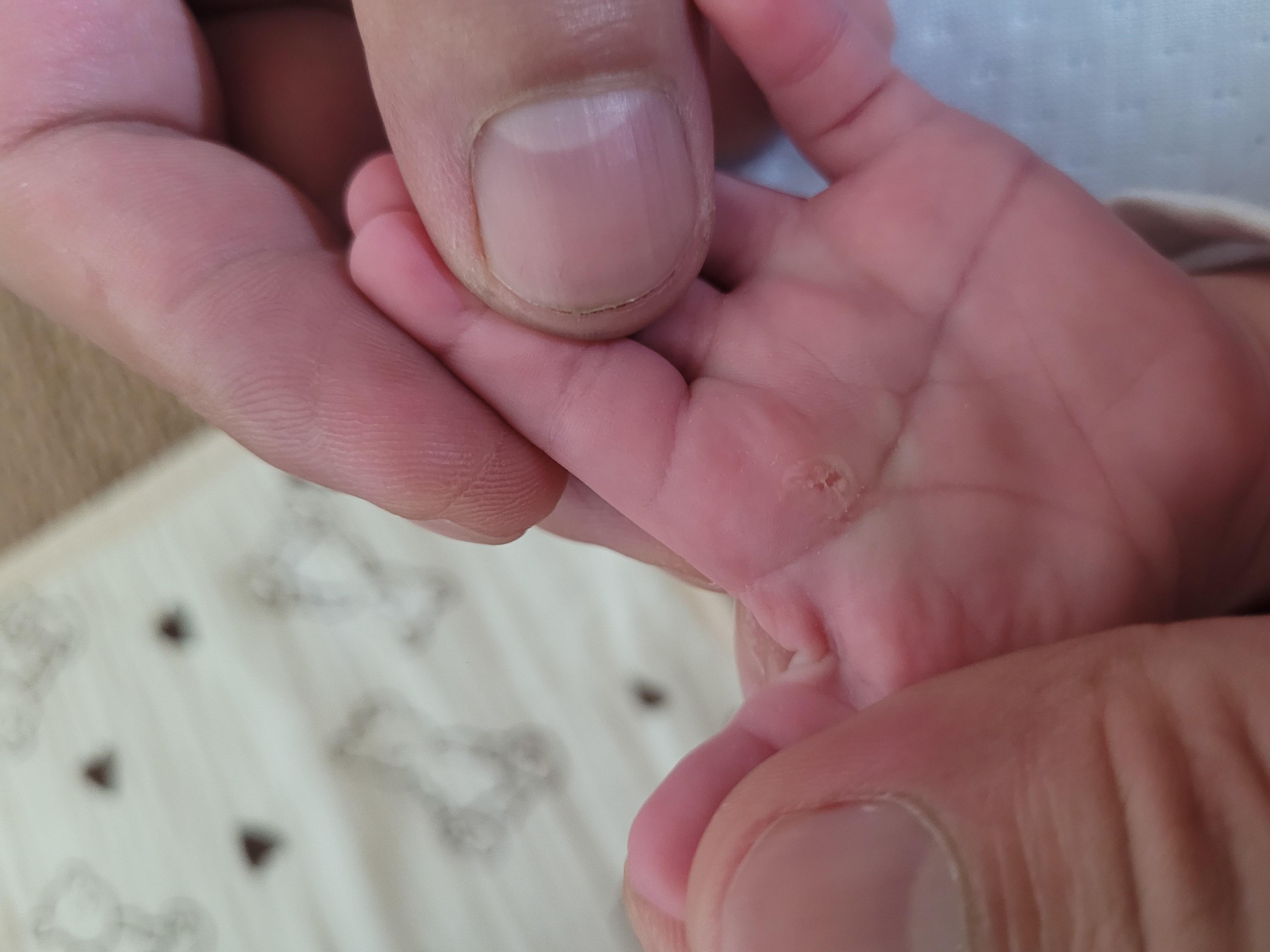 Lòng bàn tay e bé đeo bao suốt mà tự nhiên bị 1 vết gì đó