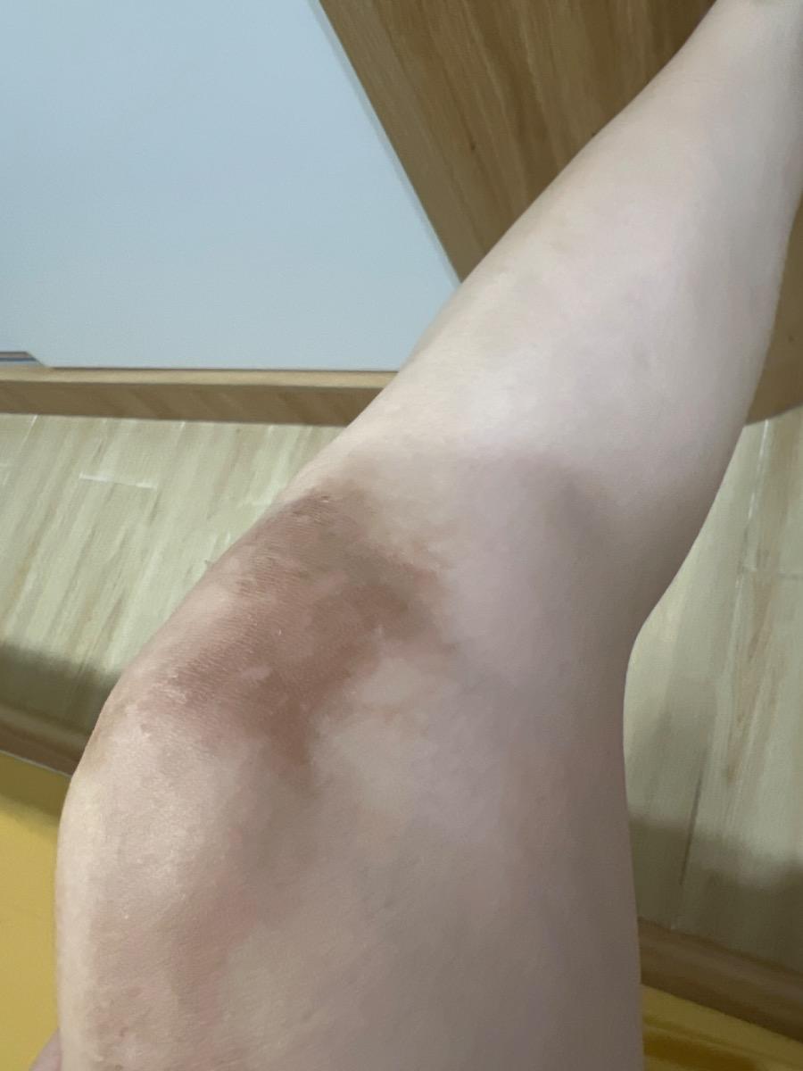 Em thai tuần 19. Có bị bỏng nhẹ ở đầu gối giờ đang để lại vết thâm. Em có thể bôi kem nghệ thorakao không hay loại nào?