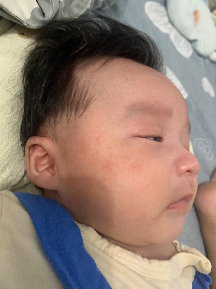 Bé nhà em bị nổi mụn giống như hình không biết có làm sao ko ạ. Nhờ mamibabi tư vấn với ạ.