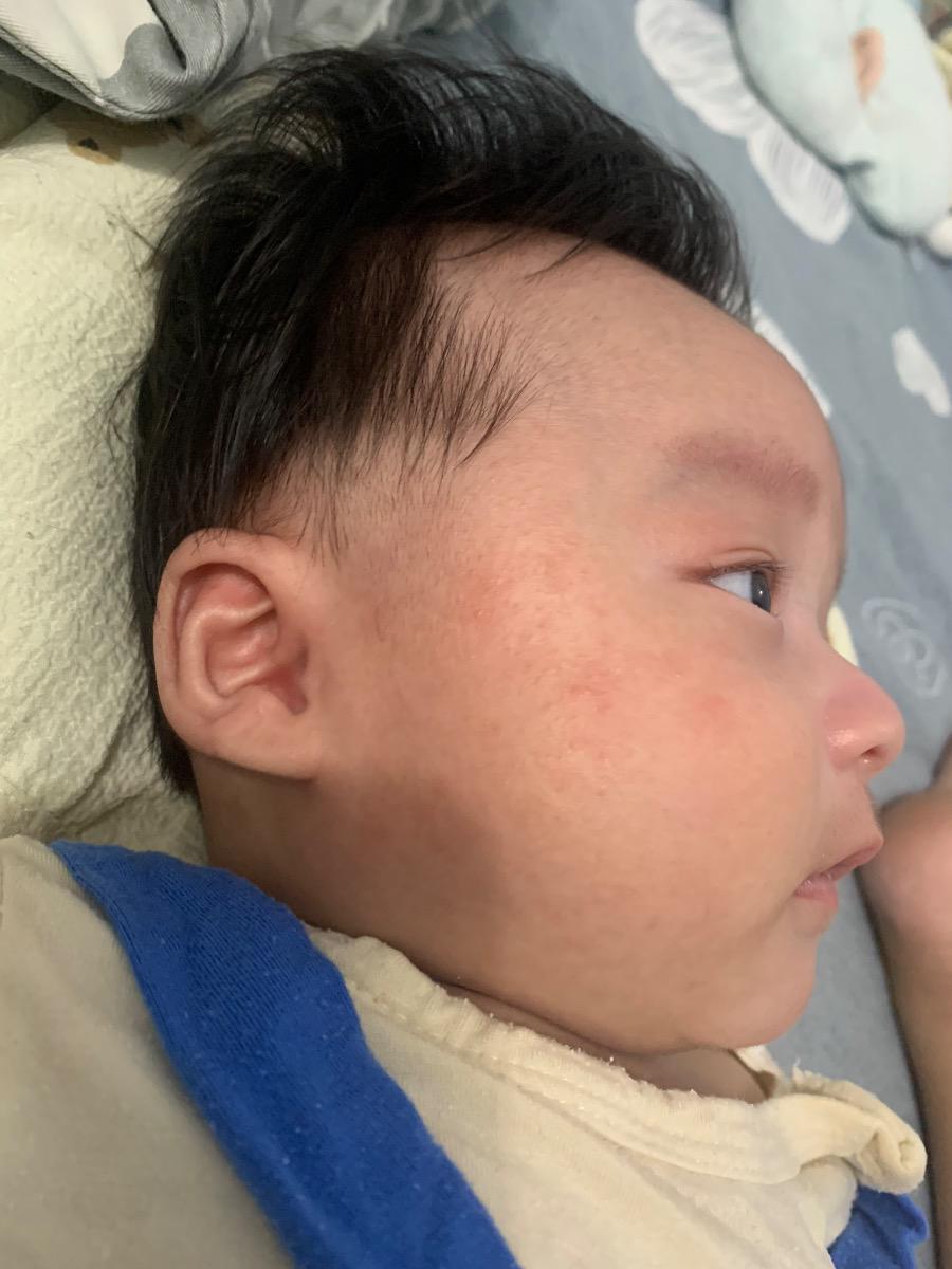 Bé nhà em bị nổi mụn giống như hình không biết có làm sao ko ạ. Nhờ mamibabi tư vấn với ạ.