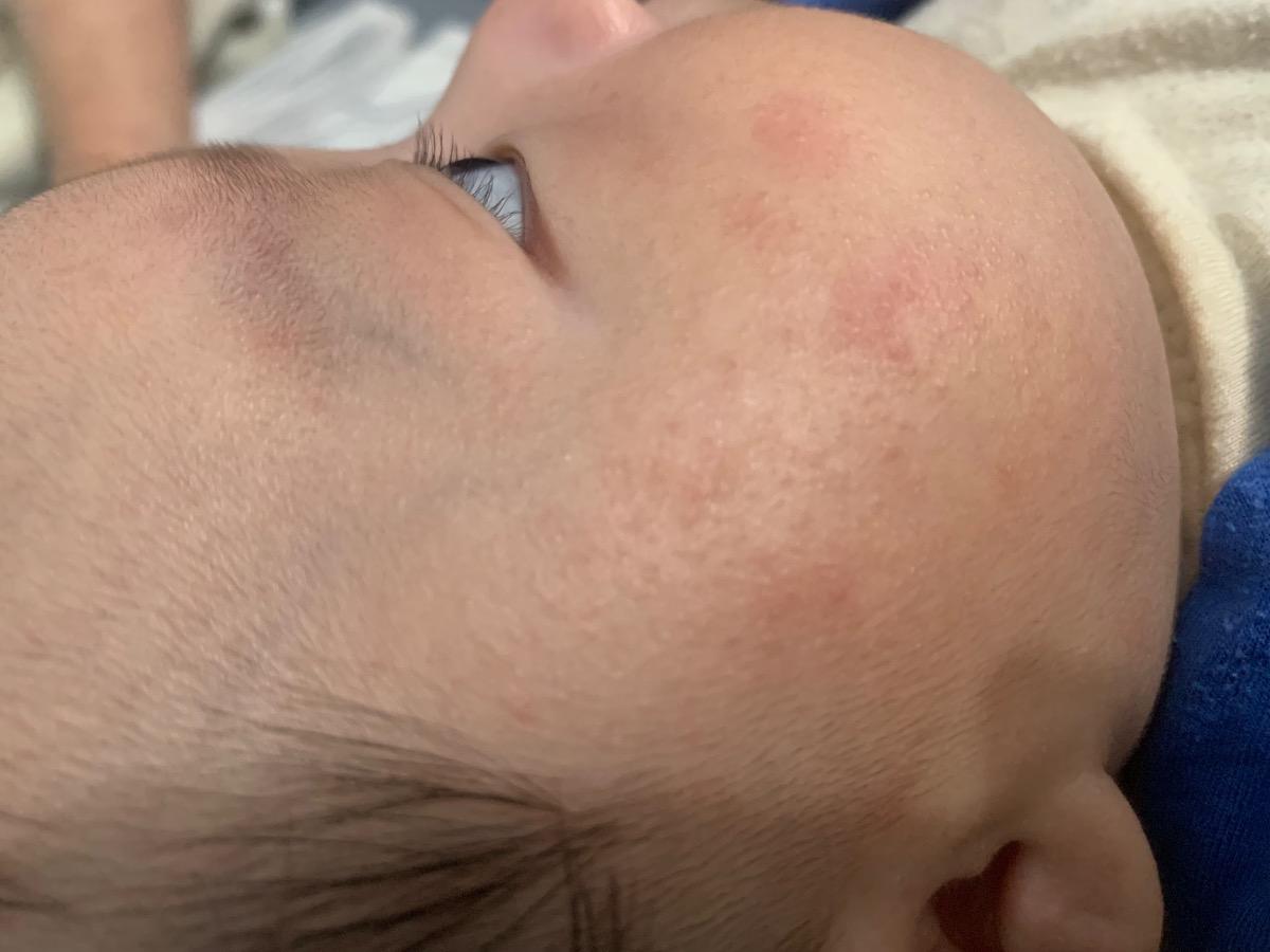 Bé nhà em bị nổi mụn giống như hình không biết có làm sao ko ạ. Nhờ mamibabi tư vấn với ạ.